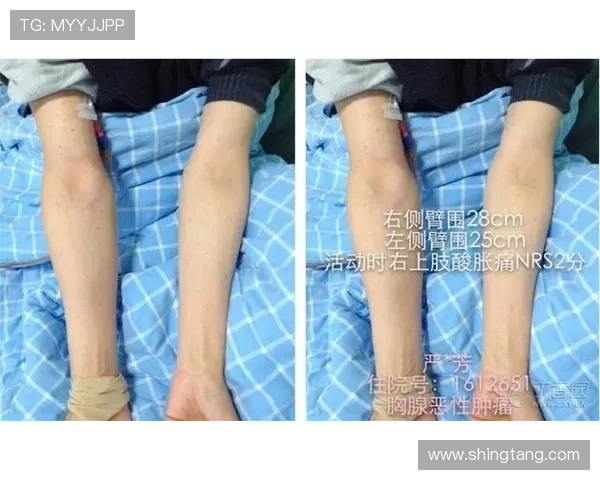 右肩深静脉血栓克复归中心! 右肩深静脉血栓克复归中心!